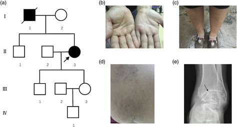 A loss of function mutation in the filaggrin gene associated with ichthyosis vulgaris and rheumatoid arthritis - Xinxin Xu, Qingqing Ma, Mu Lin, Mubo Liu, Chaolin Huang, Jianchao Ying, Jun Ye, 2021 Ichthyosis Vulgaris, Health Care Hospital, Genome Sequencing, Obstetrics And Gynaecology, Emergency Medicine, Medical University, Medical College, Free Tools, Kids Health