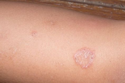 Skin Rashes and causes Ringworm Types Of Skin Rashes, Common Skin Rashes, Aloe Vera For Sunburn, Rash On Neck, Types Of Rashes, Natural Remedies For Migraines, Coconut Oil Hair Mask, Dry Skin Remedies, Home Remedies For Hair