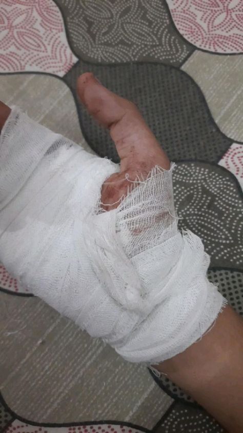 Fake Bandage Snap, Accident Snap Ideas Hand, Accident Snap Ideas, Fake Hospitalized Snaps, Bandage Snap, Accident Hand, Sick Snap, Blood Pic, Hospital Snap