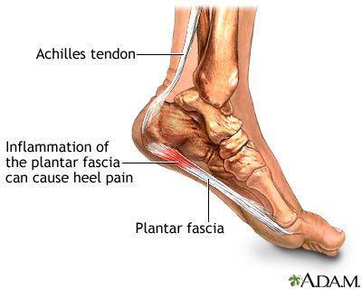 Facitis Plantar, Physiotherapy Clinic, Heel Pain, Foot Pain, Physical Therapy, Home Remedies, Fitness Models, Pie, Health