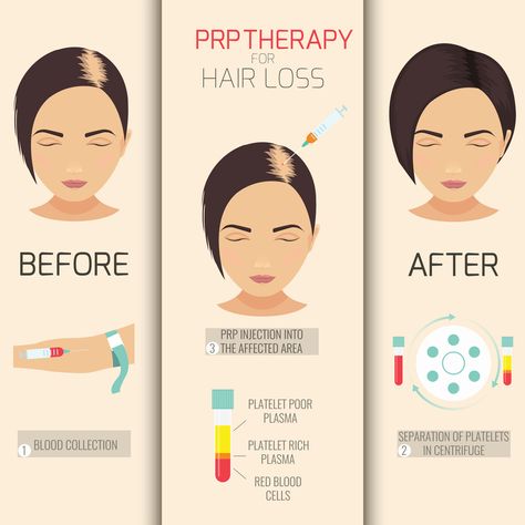 Prp Therapy, Prp Hair, Hair Transplant Procedure, Thick Hair Remedies, Platelet Rich Plasma, Male Pattern Baldness, Regrow Hair, Hair Regrowth, Hair Restoration