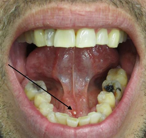 What to know about salivary stones Salivary Gland Infection, Salivary Gland Stone, Salivary Glands, Parotid Gland, Throat Infection, Not Drinking Enough Water, Salivary Gland, Sjogrens Syndrome, Strep Throat