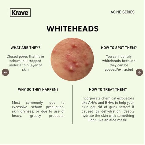 Tackling acne can be a long journey, but you don't have to feel lost! First things first, know what you're dealing with 🙌 Dermatology Notes, Whiteheads On Chin, White Head Removal, Skincare Notes, Esthetician Knowledge, Acne Quotes, Acne Awareness, Esthetician Skincare, Blind Pimple