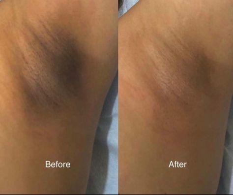 After a series of only 4 skin lightening treatments, look at the difference! Skin lightening is a gradual process that doesn't hurt in any way and provides great results. 509-961-6555 #skinlightening #sbss #barebliss #masteresthetician #yakima #skinbrightening #loveyourskin Whiten Underarm, Lightening Skin In Private Areas, Bleaching Skin Private Area, Underarm Lightening, Tomato Skin Care, At Home Skincare, Get Fair Skin, Skin Care At Home, Underarm Whitening Cream