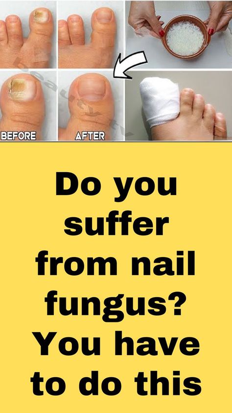 Ugly Toenails, Toenail Health, Toenail Fungal Infection, Nail Remedies, Toenail Fungus Remedies, Nail Infection, Nail Fungus Remedy, Fungal Nail, Toenail Fungus