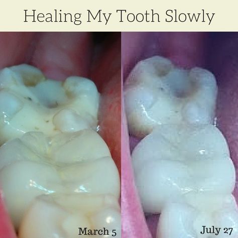 Tooth Pain Remedies, Teeth Remedies, Tooth Decay Remedies, Heal Cavities, Teeth Health, Tooth Pain, Home Health Remedies, Herbs For Health, Teeth Care