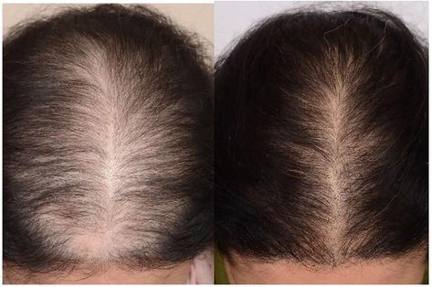 Diffuse Hair, Hair Growth Rate, Prp Hair, Rapid Hair Growth, Androgenetic Alopecia, Cosmetic Injectables, Hair Specialist, Hair Therapy, Female Hair