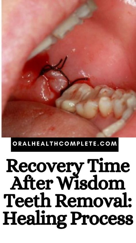 Recovery Time After Wisdom Teeth Removal Food For After Tooth Extraction, Recipes For After Wisdom Teeth Removal, After Wisdom Teeth Removal Food, How To Reduce Swelling On Face, Foods For Wisdom Teeth Removal, Soft Foods After Wisdom Teeth Removal, Wisdom Tooth Removal Food, Face Swelling Remedies, What To Eat After Wisdom Teeth Removal