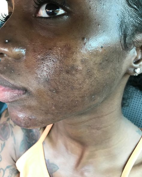 I used to suffer from hormonal & cystic acne. From around 2007-2019 I was going back & forth to the dermatologist. It was hell. My skin got worst & worst. The scarring, the dark spots, the texture, the enlarged pores & inflammation put me in a terrible mental health crisis at times. I was caking on makeup & picking my skin every single day. I went & got shots at the derm for the under the skin cysts several times a month. I spent 1,000s of dollars...I even tried #accutane but I relapsed. It g... Hormonal Cystic Acne, Bad Skin, Bad Acne, Skin Aesthetics, Bleaching Cream, Natural Acne Remedies, Mental Health Crisis, Under The Skin, Acne Solutions