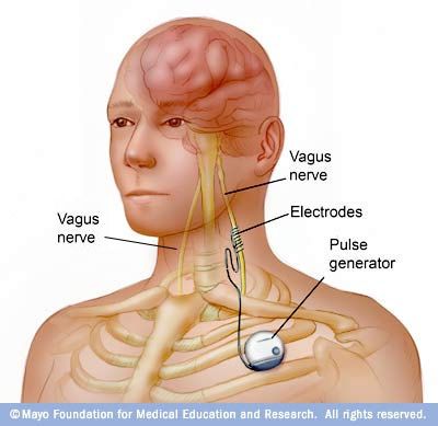 Vagal Nerve, Vagus Nerve Stimulator, Yoga Breathing Techniques, Dravet Syndrome, Nervus Vagus, Nerve Health, Gut Brain, Vagus Nerve, Central Nervous System