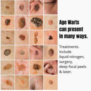 Phenol Peel, Seborrheic Keratosis, Flat Warts, Types Of Warts, Facial Warts, Remove Skin Tags Naturally, Wart Remover, Natural Homecoming Makeup, Skin Growths