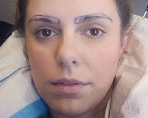 The True (And Oddly Fascinating) Story Of Eyebrow Transplants Eyebrow Hair Transplant, Eyebrow Transplant, Types Of Eyebrows, Laser Tattoo, Laser Tattoo Removal, Skin Clinic, Shaved Head, Tummy Tucks, Tattoo Removal