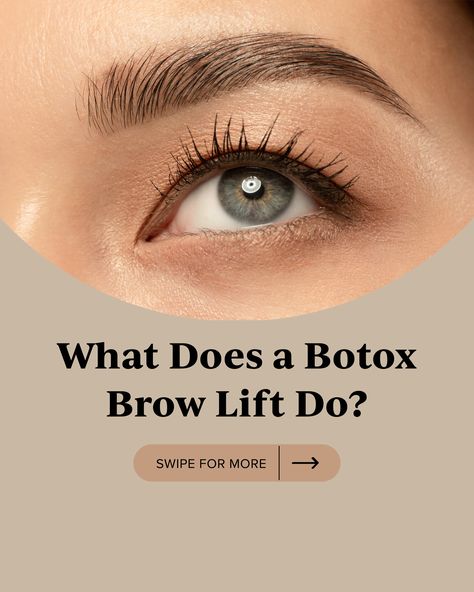 Botox Eyebrow Lift Before And After, Botox Eyebrow Lift, Eyebrow Lifting, Botox Injection Sites, Allergan Botox, Injection Sites, Botox Injection, Botox Brow Lift, Eyebrow Before And After