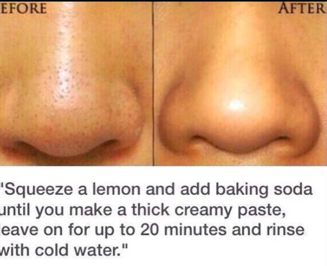 Health tips Jus Lemon, Blackhead Remedies, Black Heads, Get Rid Of Blackheads, Beauty Remedies, Acne Remedies, Skin Pores, Homemade Beauty Products, Skin Tips