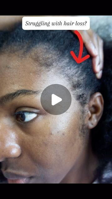 Your Hair Growth Guide 👸🏾 | 🚨 Struggling with Hair Issues? These Herbs Could Be the ANSWER! 🌱

Whether it’s hair loss, shedding, or damaged follicles, there’s a... | Instagram Treating Dandruff, Prevent Dandruff, Hair Issues, Hair Shedding, Hair Remedies, Dandruff, Beauty Industry, Ayurveda, For Hair