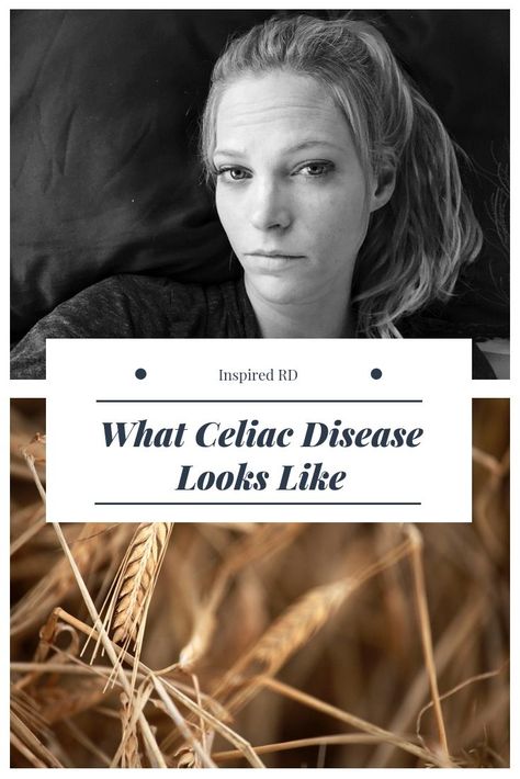 What Is Celiac, Celiac Symptoms, Celiac Diet, Female Facial Hair, Celiac Awareness, Newborn Feeding, Gluten Sensitivity, Healthy Lifestyle Habits, Gluten Intolerance