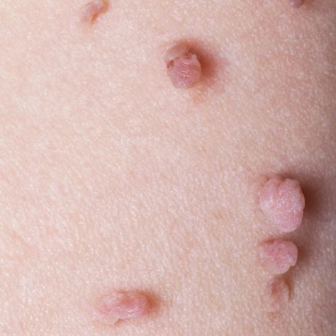 What causes Skin Tags? Causes Of Skin Tags, Remove Skin Tags Naturally, Remove Skin Tags, Pregnancy Skincare, Skin Moles, Mole Removal, Skin Tags, Baking Soda Shampoo, Skin Remedies