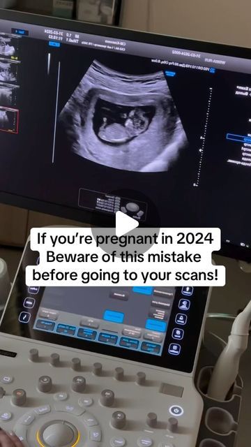 Snapframe | Live Ultrasound Frame on Instagram: "LlNK lN BlO to get your ultrasound frame🥰👉🔗" 10 Week Ultrasound Pictures, 8 Weeks Pregnant Ultrasound, Boy Ultrasound Pictures, Ultrasound Picture Ideas, Baby Gender Ultrasound, 4d Ultrasound Pictures, 10 Week Ultrasound, Ultrasound Humor, Boy Ultrasound