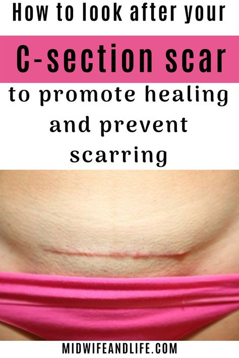 How to look after your c-section scar to promote healing and prevent scarring. C-section, caesarean, cesarean, c-section scar, wound healing, reduce scarring on c-section, looking after your c-section, can I drive after c-section, recovery rate c-section C Section Incision Healing, C Section Scar Healing, C Section Scar Massage, Cesarian Section, C Section Scar Tattoo, C Section Scar, C Section Scars, C Section Recovery, Scar Reduction