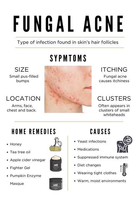 Back Acne Remedies, Blind Pimple, Fungal Acne, Forehead Acne, Pimples Under The Skin, Bad Acne, Prevent Pimples, Natural Acne Remedies, Types Of Acne