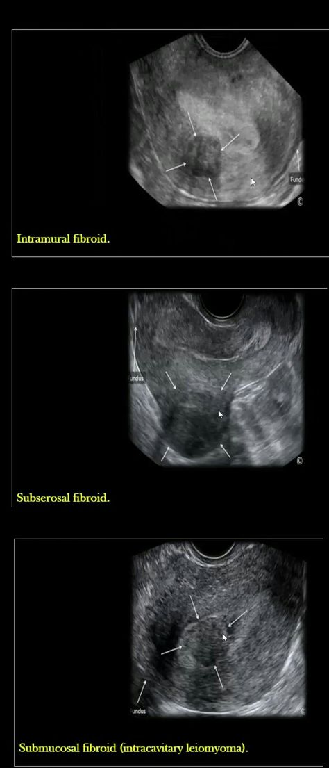 Obgyn Sonography Student, Ultrasound Technician Student, Uterus Ultrasound, Sonography Humor, Ultrasound Humor, Ob Ultrasound, Ultrasound Student, Gyn Ultrasound, Bicornuate Uterus