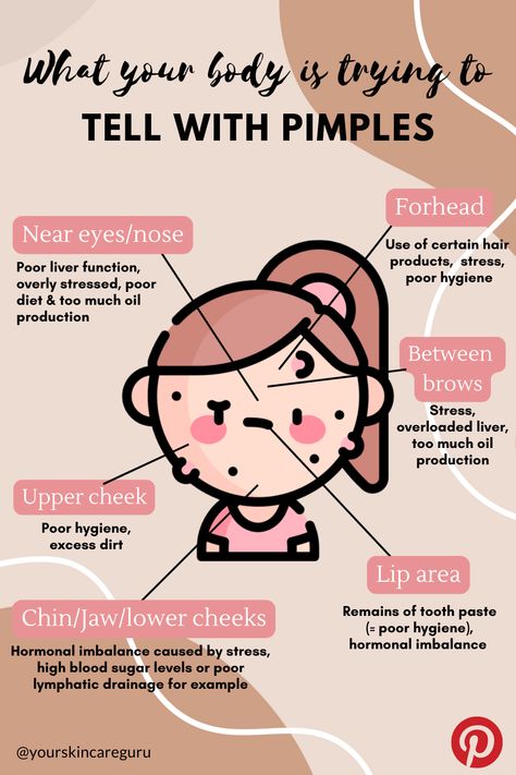 What Do Your Pimples Mean, Pimples Reasons Faces, Pimple Face Guide, Causes Of Pimples On Face, What Pimples In Different Places Means, Reasons Of Pimples On Face, Placement Of Pimples Meaning, Reasons For Pimples On Face, Acne On Chest Meaning