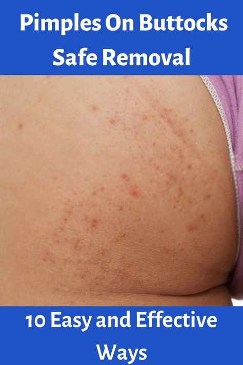 Pimples On Buttocks Safe Removal - 10 Easy and Effective Ways How To Get Rid Of Buttocks Acne Quick, How To Get Rid Of Pimples On Buttocks, How To Get Rid Of Bumps On Buttocks, How To Get Rid Of Buttocks Acne, Leg Pimples, Bumps On Legs, Buttocks Acne, How To Treat Pimples, What Causes Pimples