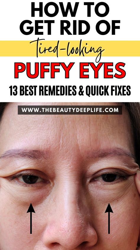 Don't let puffy eyes bring you down! Discover easy fixes for those pesky eye bags, fine lines, and tired-looking eyes. From genius skincare hacks to makeup tricks and lifestyle remedies, we've got you covered. Say goodbye to puffiness and hello to refreshed, youthful eyes. Start your journey towards bright-eyed beauty now! How To Depuff Eyes, Eye Bag Remedies, Eye Bags Makeup, Puffy Eyes Remedy, Baggy Eyes, Eye Bags Treatment, Skin Care Home Remedies, Skincare Solutions, Skincare Hacks