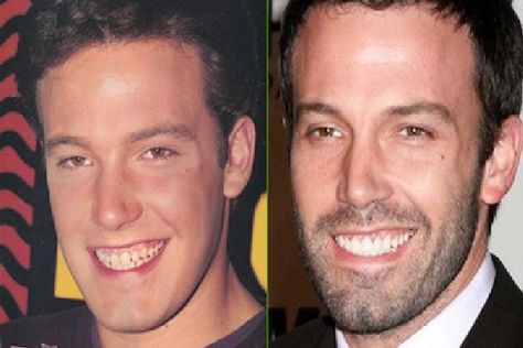 Ben There Done That-Celebrities who have fixed their teeth Celebrities With Veneers, Braces Humor, Celebrity Teeth, Dental Makeover, Celebrity Smiles, Denture Implants, Laser Teeth Whitening, Fake Teeth, Dental Life