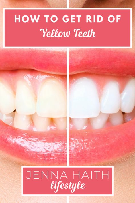 Have yellow stained teeth ever made you feel too conscious of smiling? Along with practicing good oral hygiene, there are a few other steps you can take to whiten your teeth, such as home remedies like baking soda and hydrogen peroxide, lemon juice, and more. Read on to learn more! The post How To Get Rid Of Yellow Teeth appeared first on Jenna Haith Lifestyle. How To Get Rid Of Yellow Teeth, Get Rid Of Yellow Teeth, Lemon Juice And Baking Soda, Baking Soda Hydrogen Peroxide, Baking Soda Teeth, Teeth Aesthetic, Teeth Remedies, Straight Smile, Family Dental Care