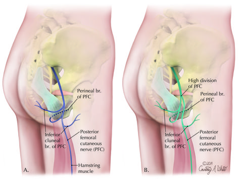 Pinched Nerve In Buttocks, Femoral Nerve Pain Relief, Pelvic Congestion Syndrome, Body Muscle Anatomy, Hip Anatomy, Femoral Nerve, Nurse Skills, Muscle System, Hip Pain Relief