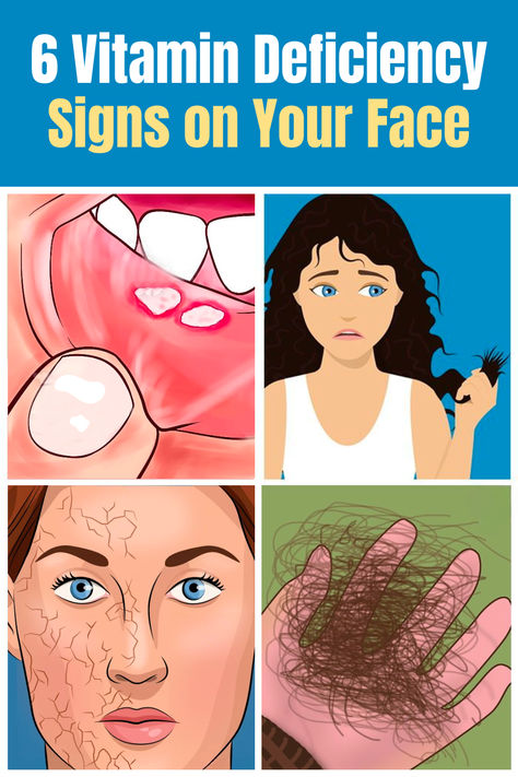 Signs of vitamin deficiency on the face may include a pale complexion, dry or flaky skin, acne or breakouts, angular cheilitis, dark circles, and premature aging, highlighting the importance of proper nutrition for skin health. #nails #nailhealth #vitamindeficiency #brittlenails Vitamin Deficiency Chart, Mineral Deficiency Signs, Vitamin Deficiency Symptoms, Angular Cheilitis, Health Nails, Mineral Deficiency, Pale Complexion, Nail Vitamins, Flaking Skin