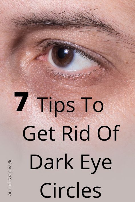 Learn all about dark circles under your eyes. Discover how to lessen their appearance or get rid of them permanently. Dark Cycles Under Eyes, Black Undereye, How To Get Rid Of Dark Circles Under Eye, Dark Rings Under Eyes, Dark Under Eye Circles, Skin Massage, Dark Eye Circles, Brown Spots Removal, Under Eye Puffiness