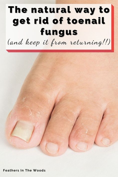 Nail Remedies, Fingernail Fungus, Toenail Fungus Remedies, Nail Infection, Nail Fungus Remedy, Fungal Nail, Ingrown Toe Nail, Toenail Fungus, Nail Fungus