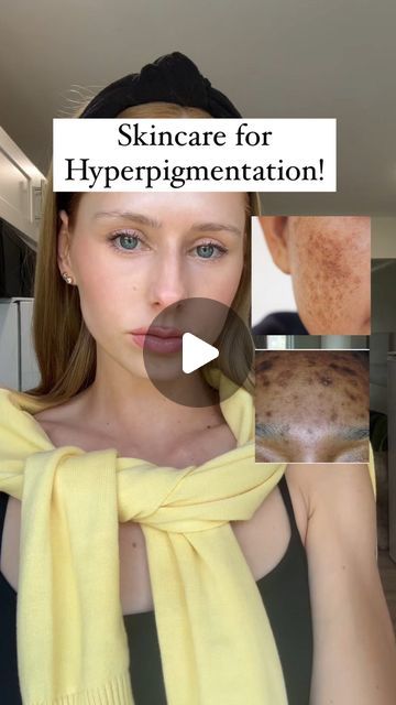 Maja on Instagram: "✨As promised I will be giving skincare recommendation for hyperpigmentation!   ✨Starting off strong with Hydroquinone! I Know many people are nervous to use a hydroquinone cream but when used properly and monitored by a skin specialist the results are stunning!   I linked the product in my bio ✨  #hydroquinone #hyperpigmentationtreatment #melasmatreatment #hyperpigmentation #skincaretips   What do you struggle with?" Hydroquinone 4% Before And After, Phenol Peel, Hyperpigmentation Mask, Skin Care Hyperpigmentation, Dermatologist Skin Care, Hydroquinone Cream, Post Inflammatory Hyperpigmentation, Treating Hyperpigmentation, Skin Specialist