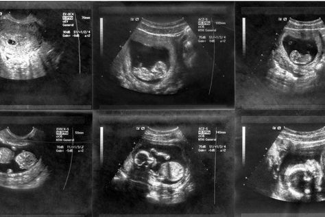 12 Week Ultrasound Pictures, 10 Week Ultrasound Pictures, 11 Week Ultrasound, 5 Weeks Pregnant Ultrasound, 10 Week Ultrasound, 12 Week Ultrasound, Baby Ultrasound Pictures, Pregnancy Scan, 11 Weeks Pregnant