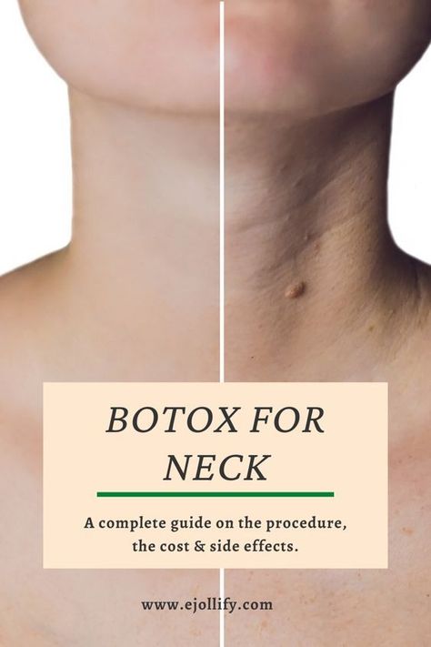 Neck Fillers Before And After, Neck Tightening Procedures, Botox In Neck, Botox Neck Before After, Neck Botox Before And After, How To Remove Neck Lines, Botox Areas On Face, Natural Botox For Face, Jaw Botox Before After