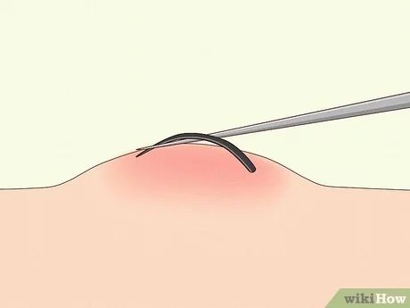 3 Simple Ways to Remove Deep Ingrown Hairs - wikiHow Ingrown Facial Hair Women, How To Get Rid Of Ingrown Hairs On Vag, How To Get Rid Of Ingrown Hairs, Ingrown Hair Under Armpit, Ingrown Eyebrow Hair, How To Remove Ingrown Hair, Ingrown Hair Removal Videos, Remove Ingrown Hair, Infected Ingrown Hair