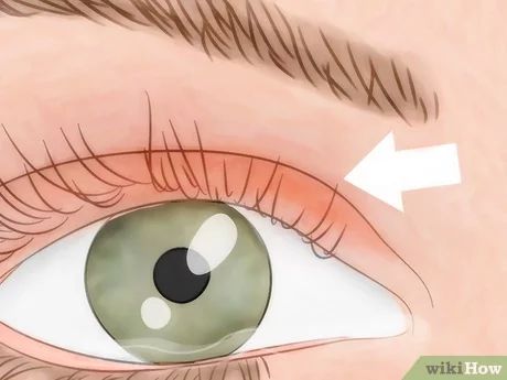 How to Know if You Have Eye Mites: 10 Steps (with Pictures) Eye Mites, Mites On Humans, Demodex Mites, Dust Mite Allergy, Tea Tree Oil Shampoo, Watery Eyes, Itchy Eyes, Bug Repellent, Arachnids