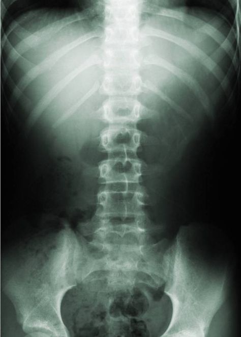 Have a straight Spine. Apologia Biology, Rectus Abdominis, Xray Art, Inversion Table, Spinal Decompression, Doctor Of Chiropractic, Spinal Injury, Personal Injury Lawyer, Chiropractic Care