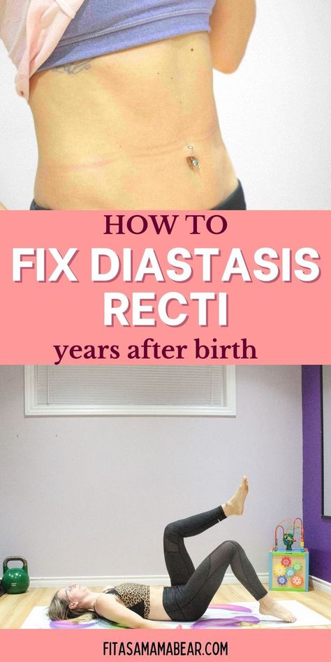 There’s no “expiry date” on when you can work on healing from pregnancy. Use these diastasis exercises and tips to help heal your abs no matter where you are in your postpartum journey @fitasamamabear #diastasis #diastasisrecti #postpartum #postpartumhealing Diastasis Exercises, Fix Diastasis Recti, What Is Diastasis Recti, Postpartum Workouts, Healing Diastasis Recti, Diastasis Recti, Glute Bridge, It's Never Too Late, Postpartum Recovery