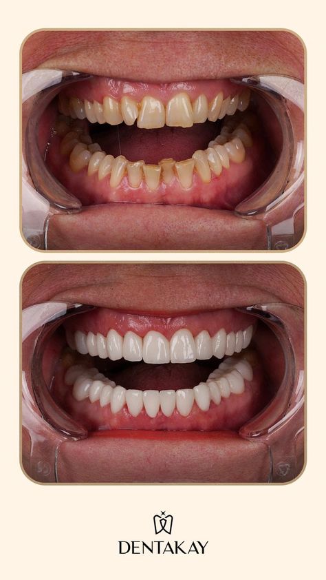 Follow us on Pinterest for more inspiring before and after photos! #zirconia #zirconiumveneers #veneersbeforeafter #crownsbeforeafter #zirconiabeforeafter #beforeafterdentaltreatment Logo Before And After, Dental Veneers Before And After, Teeth Before And After, Dental Before And After, Dental Implants Before And After, Veneers Before And After, Teeth Makeover, Dental Makeover, Loose Teeth