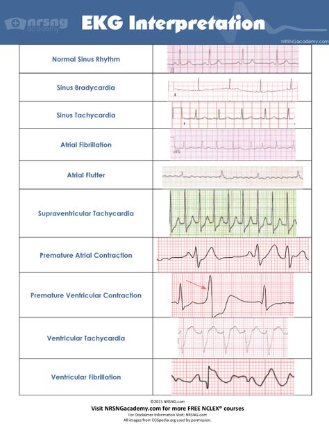 Ekg Rhythms, Ekg Tattoo, Ekg Interpretation, Nursing Cheat Sheet, Medical Assisting, Ecg Interpretation, Nursing Information, Nursing Cheat, Nursing Mnemonics