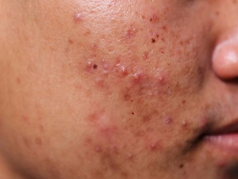 These powerful close-up photos of acne will change the way you think about your skin Acne Photos, Back Acne Remedies, Blind Pimple, Prevent Pimples, Pimples Under The Skin, Forehead Acne, Natural Acne Remedies, How To Remove Pimples, Skin Photo