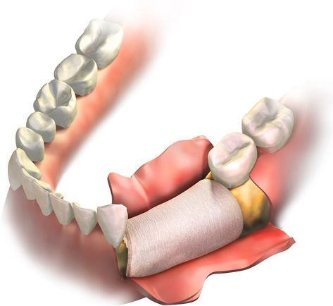 Bone grafting may be a necessary part of the implant process to prepare the jawbone for surgery, and here’s why you may need one in Woodbridge #bonegraft #implant #dentist Bone Grafting Teeth, Dental Logos, Preparing For Surgery, Tooth Infection, Dental Implant Procedure, Implant Dentist, Columbia Maryland, Bone Grafting, Dental Implant Surgery