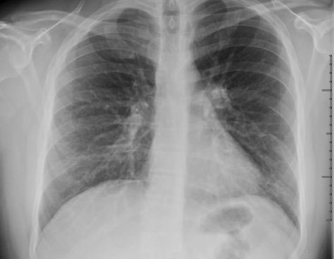 Mycoplasma-Induced Rash and Mucositis: 2 Cases in Adults | Consultant360 Steven Johnson Syndrome, Childhood Asthma, Urgent Care Clinic, Soft Palate, Critical Care Nursing, Sinus Congestion, Infectious Diseases, Blood Cells, Medical History