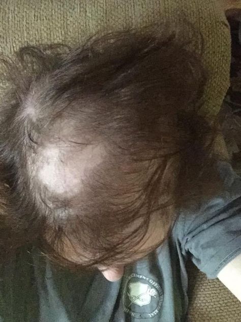 Explaining My Hair Loss to My Daughter - Alopecia and female pattern baldness due to chemotherapy. Click the pin to read more or pin it to save for later! Accelerate Hair Growth, Female Pattern Baldness, Going Bald, Male Pattern Baldness, Hair Patterns, Pattern Baldness, Bald Women, Bald Head, Bald Heads