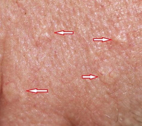 How To Clear Bumpy Skin, Bumps On Face Not Acne, Face Bumps Not Acne, Skin Bumps On Face, White Bumps On Face, Sebaceous Hyperplasia, Bumps On Face, Crusty Skin, Forehead Bumps