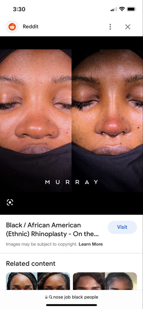 Pretty Lip Fillers, Rhinoplasty Before And After Black Women, Nose Job Before And After Black, Nose Jobs Black Women, Black Women Nose Job, Rhinoplasty Black Women, Thick Skin Nose Job, Flat Wide Nose, Flat Button Nose