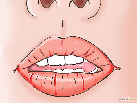 Wtf is happening and what can you do about it? Warning: Somewhat graphic cracked lip photos ahead. Canker Sore Remedy, Remedies For Dry Mouth, Tooth Repair, Lips Photo, Fresh Aloe Vera, How To Dry Sage, Canker Sore, Dry Mouth, Inflammation Causes